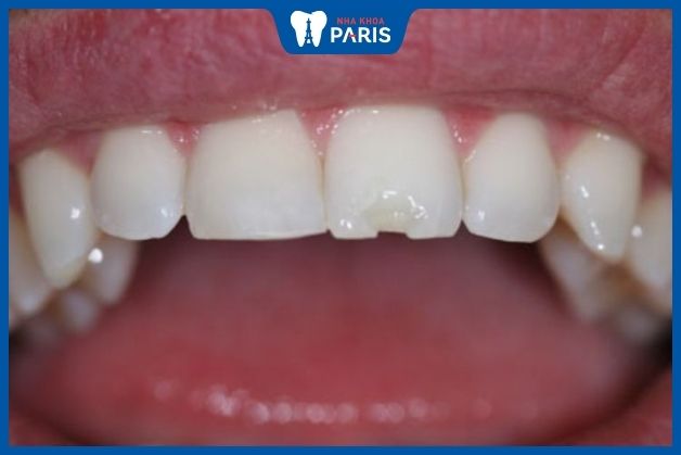 Răng sứ kém chất lượng thường sứt mẻ sau một thời gian ngắn sử dụng