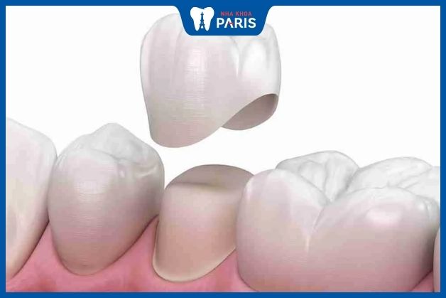 Bọc lại răng sứ mới trong trường hợp răng cũ hỏng nặng, không thể sửa chữa