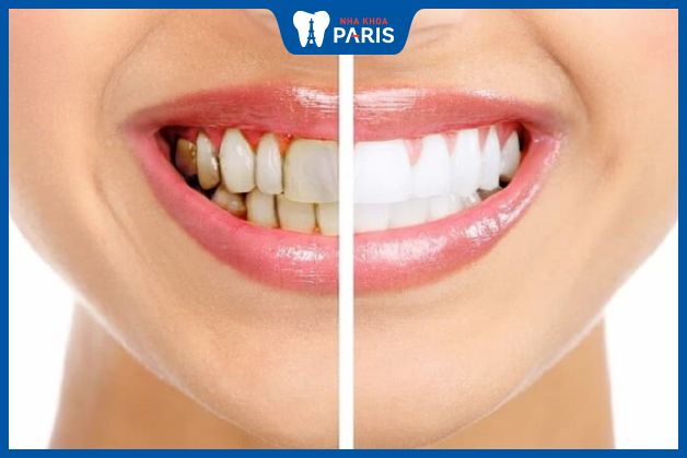 Răng sứ kém chất lượng thường nhanh xỉn màu hơn răng sứ cao cấp