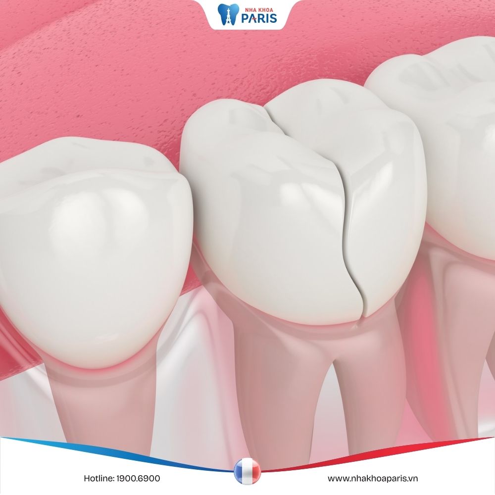 Những hậu quả bọc răng sứ kém chất lượng và cách xử lý