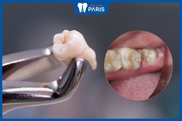 Nhổ răng khôn sớm ngăn chặn bệnh lý