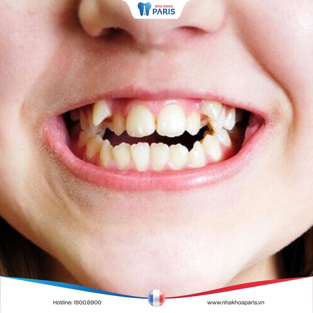 Răng mọc chồi: Triệu chứng, cách chăm sóc và giải pháp giảm đau