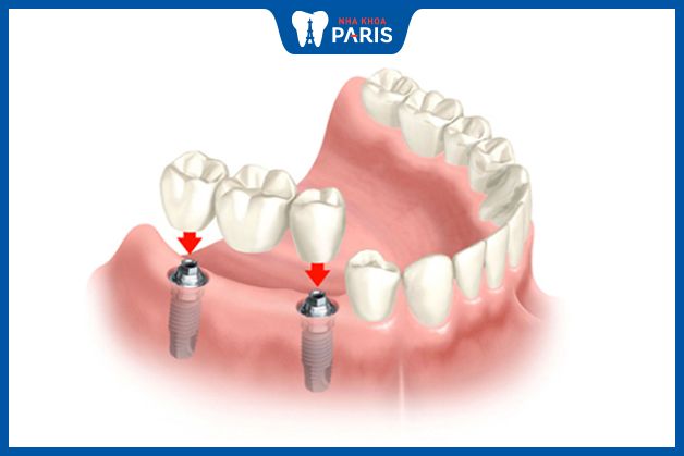 Trồng răng Implant giá bao nhiêu phụ thuộc vào số lượng trụ