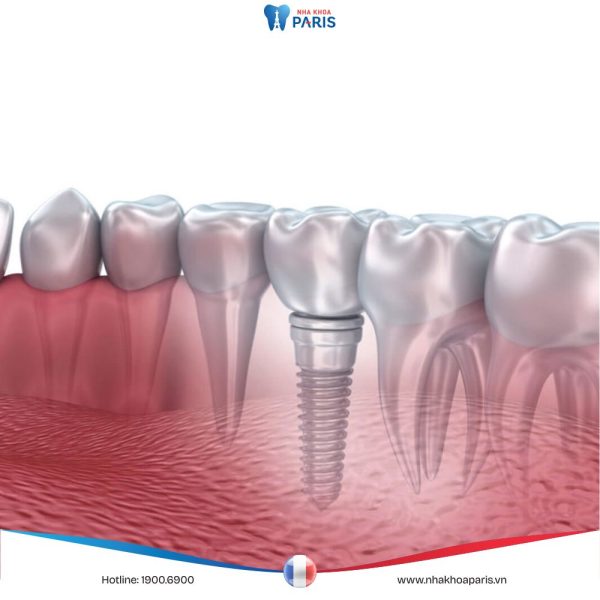 Trồng răng Implant giá bao nhiêu – 3 yếu tố tác động đến giá