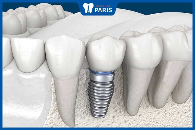 Cấy ghép răng Implant là phương pháp duy nhất có thể ngăn chặn tiêu xương