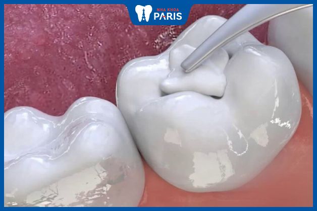 Vết đen do sâu răng có thể được xử lý bằng cách trám composite