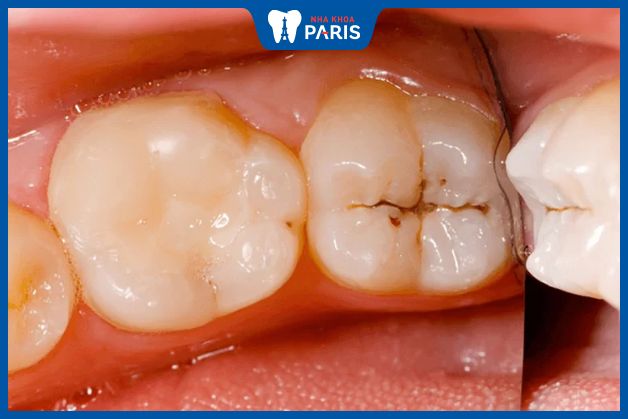 Răng khôn xuất hiện vết đen thường được được bác sĩ khuyên nhổ bỏ