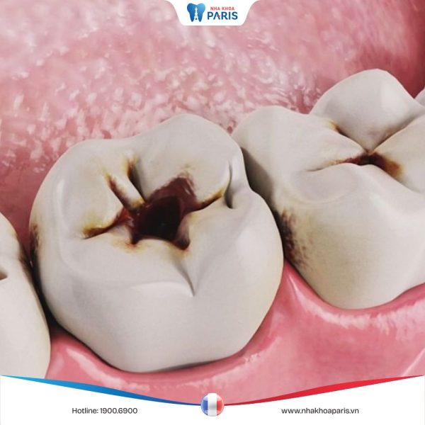Vết đen trên răng hàm: Nguyên nhân và cách loại bỏ