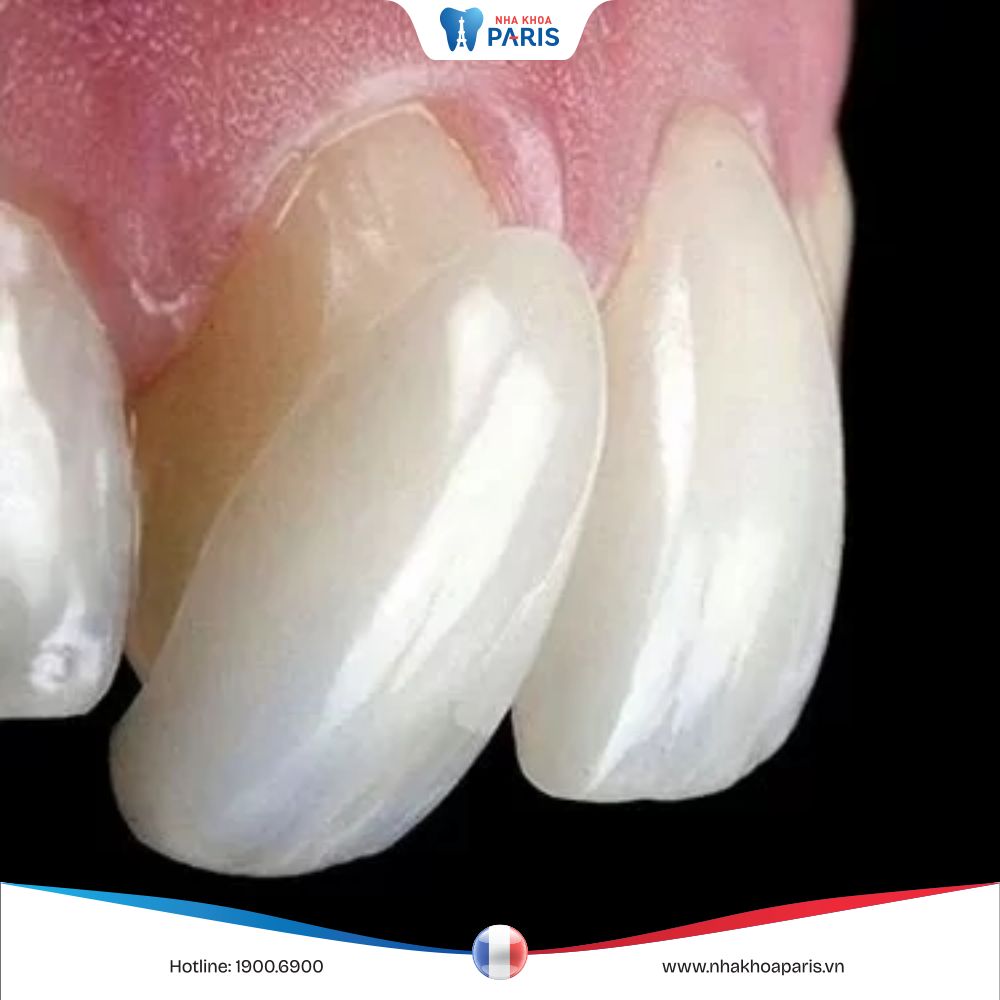 Những dấu hiệu răng sứ bị hở và cách khắc phục hiệu quả