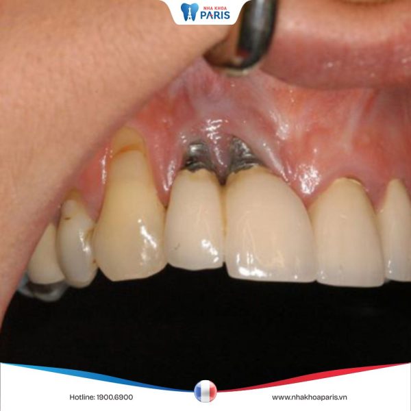 Những tác hại của việc trồng răng Implant không thể chủ quan