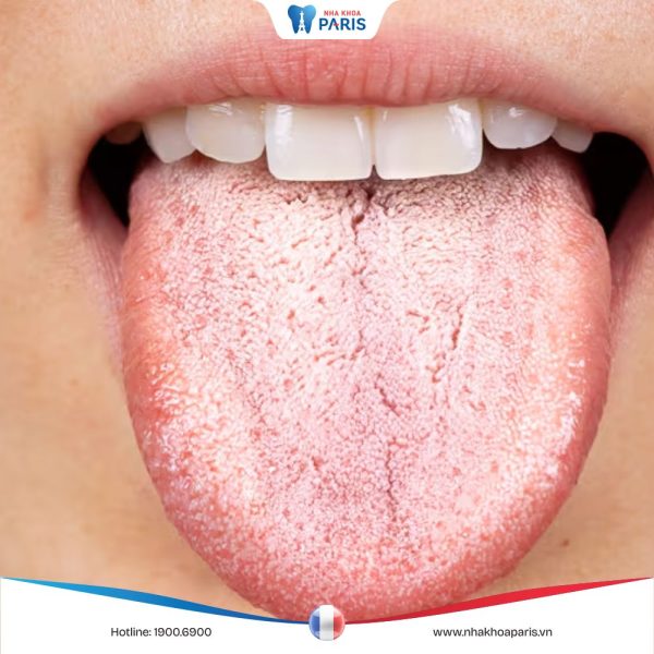 Hình ảnh nấm lưỡi ở người lớn giúp chẩn đoán bệnh rõ nhất