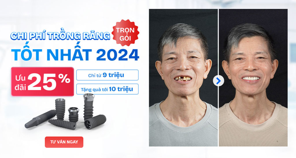 Chi phí trồng răng implant tốt nhất năm 2024