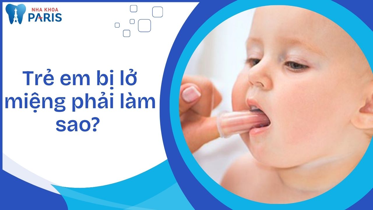 Trẻ em bị lở miệng phải làm sao? Cách điều trị hiệu quả nhất