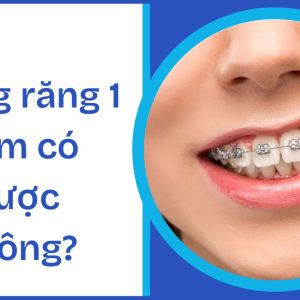Niềng răng 1 hàm có được không? Tìm hiểu các trường hợp và phương pháp
