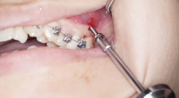 Bắt vít niềng răng không đau vì được tiêm thuốc tê