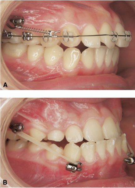 Mức độ đau nhức do cắm vít khi niềng răng sẽ khác nhau