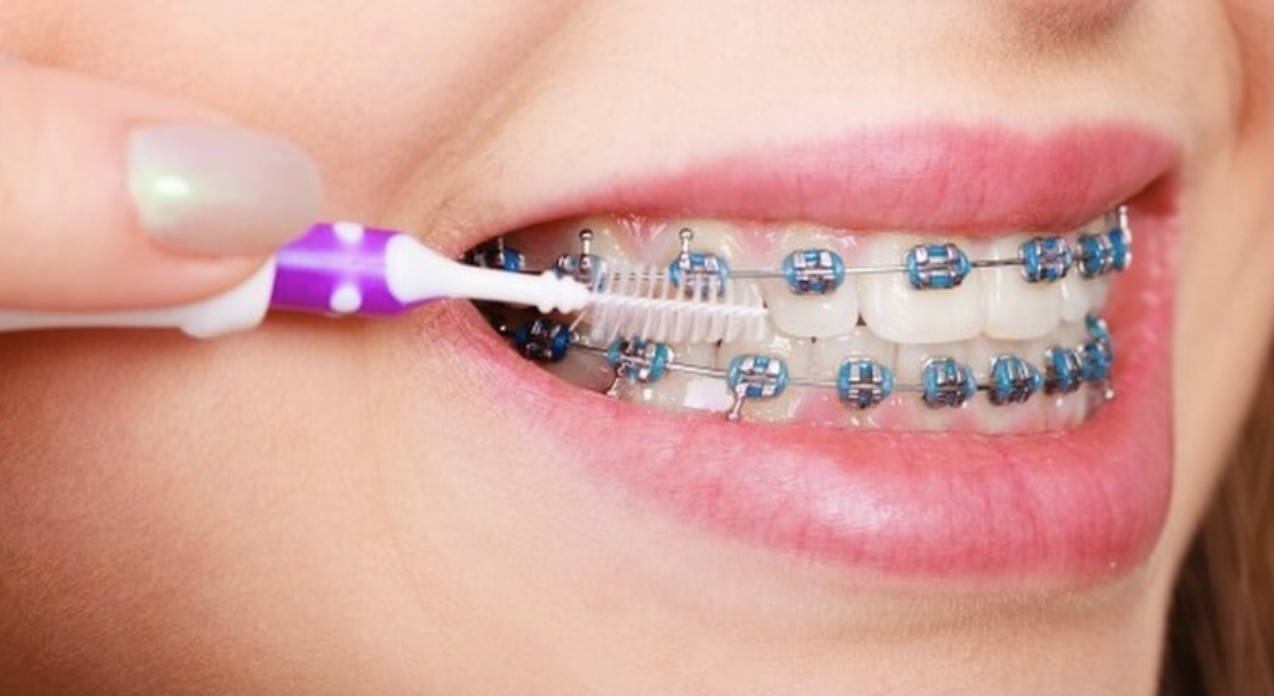 Chăm sóc răng miệng kĩ để tránh viêm nhiễm, đau nhức