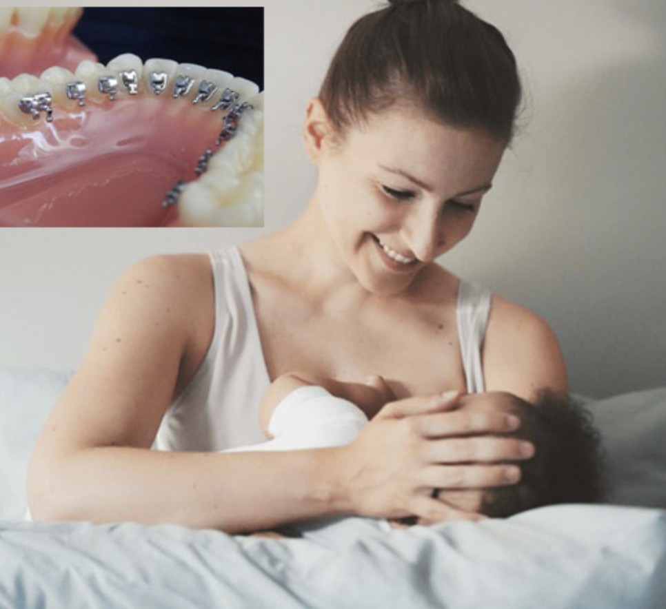 Các mẹ đang cho con bú hoàn toàn có thể niềng răng