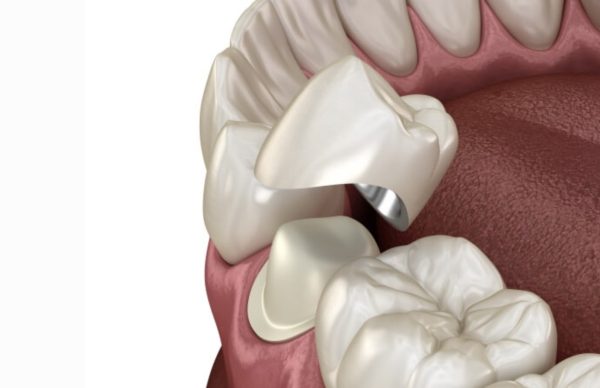 Giá trồng răng sứ kim loại phụ thuộc nhiều vào chất liệu răng