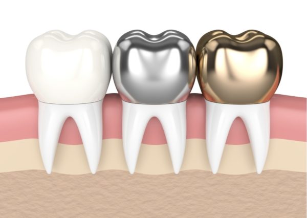 Giá trồng răng sứ kim loại bao nhiêu? Chi phí mới nhất