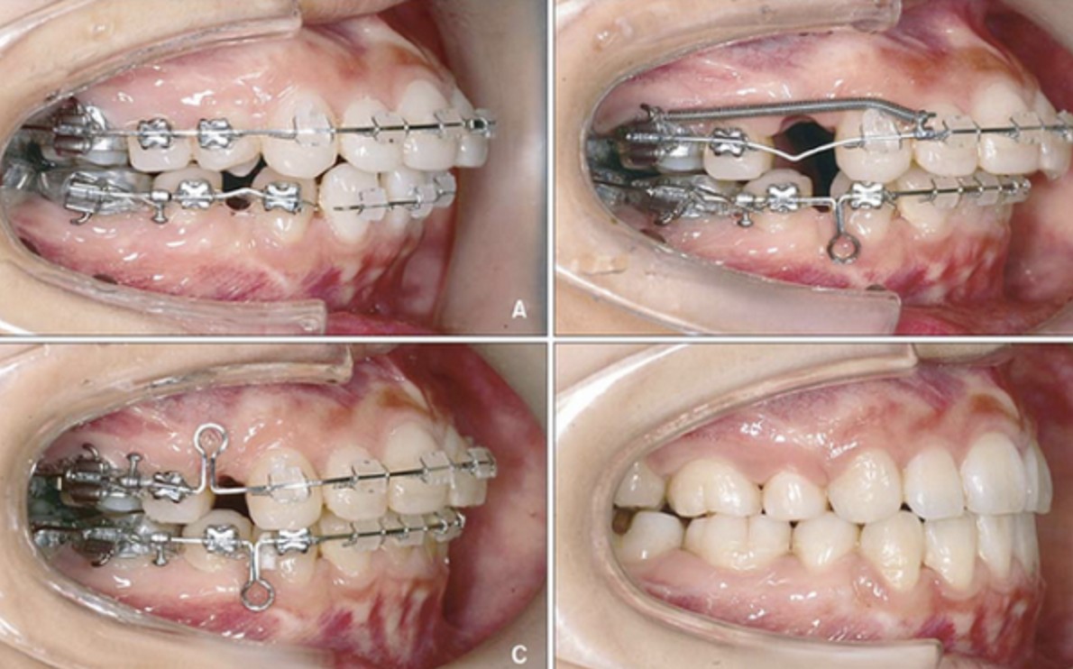 Niềng răng mắc cài cho răng sai lệch, chen chúc nhiều