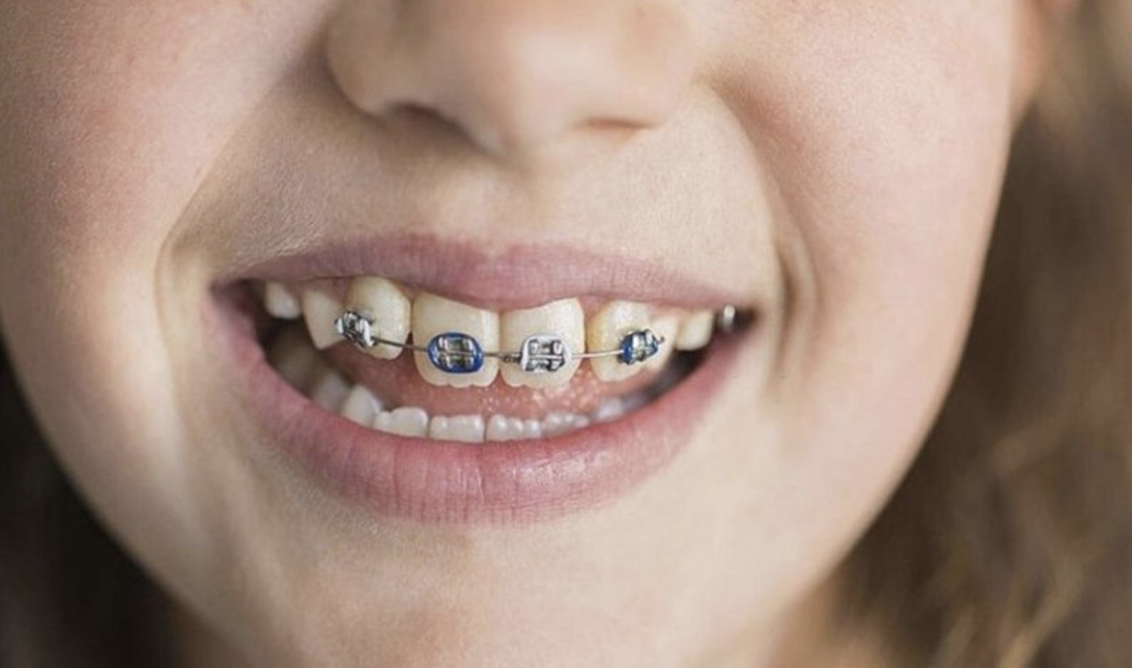 Niềng 4 răng cửa sẽ có chi phí tương đương niềng cả hàm hoặc 2 hàm