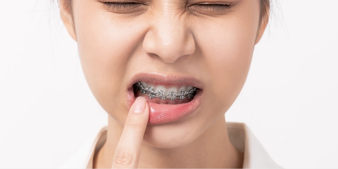 Mới gắn mắc cài và siết răng sẽ gây khó khăn khi ăn