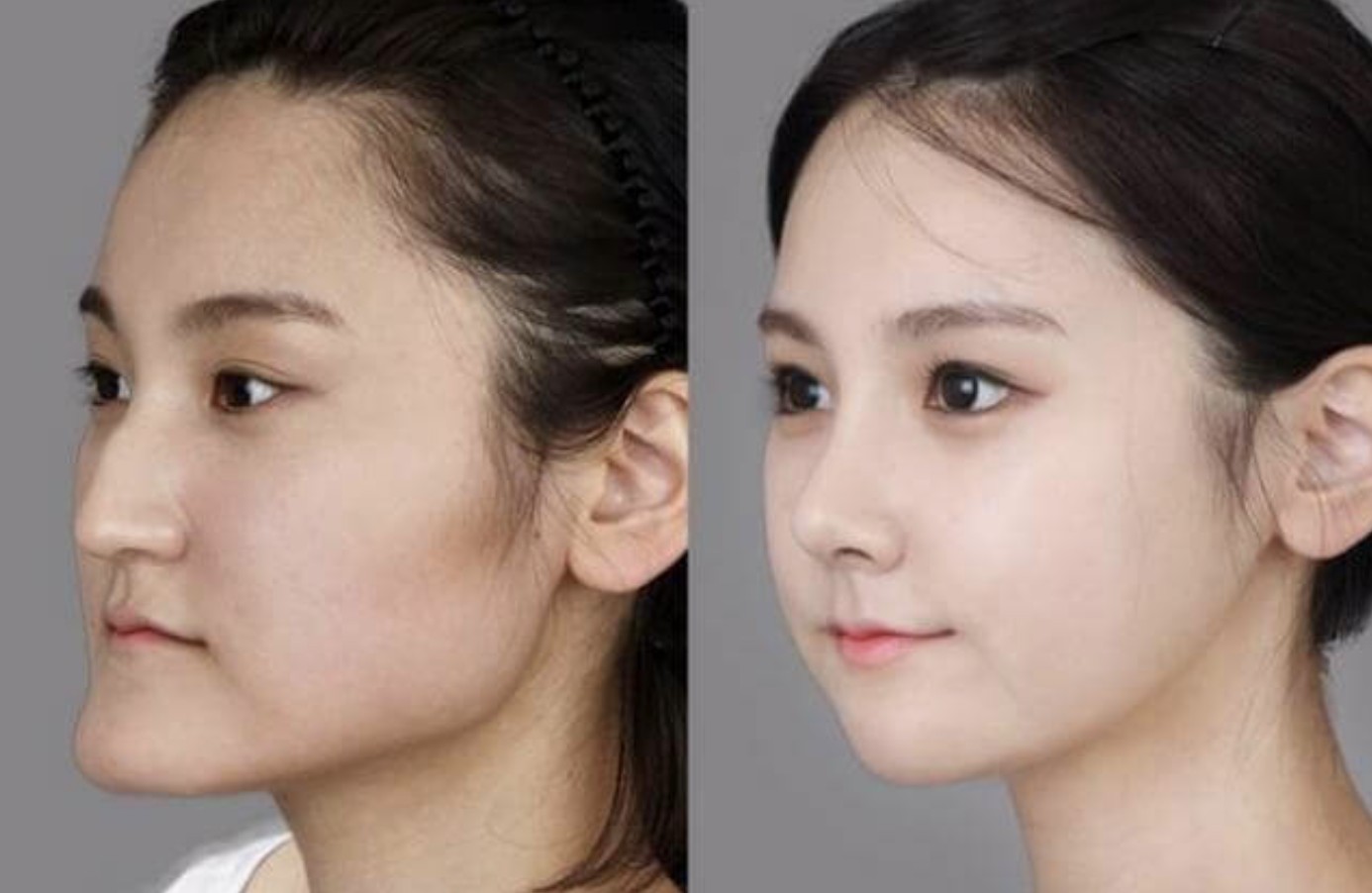 Gương mặt sau khi niềng răng trở nên nhỏ gọn hơn
