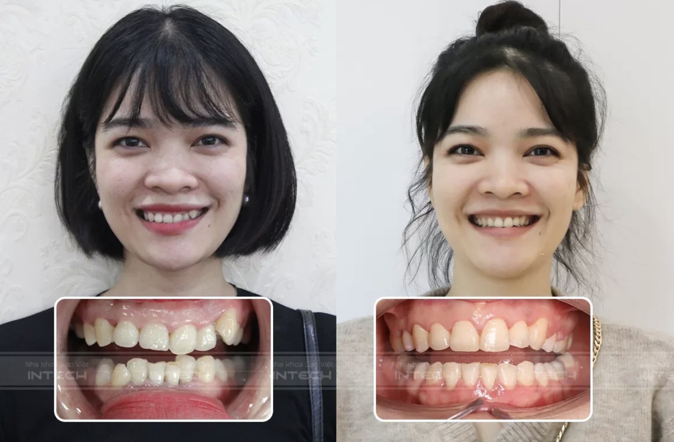 Răng cắn hở sau khi niềng đã giúp gương mặt cân đối hơn