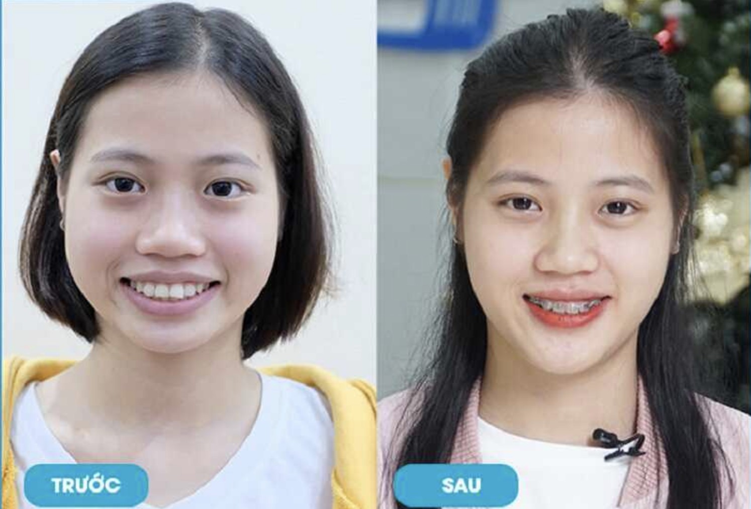 Sau khi tháo niềng gương mặt thay đổi đáng kể