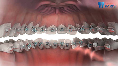 Các khí cụ được gắn phía trong của răng