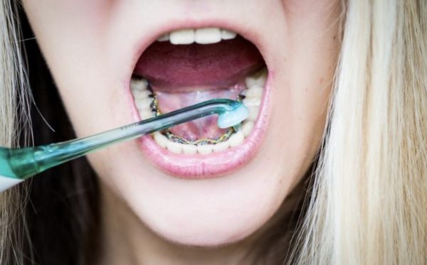 Niềng răng mắc cài mặt lưỡi khó vệ sinh