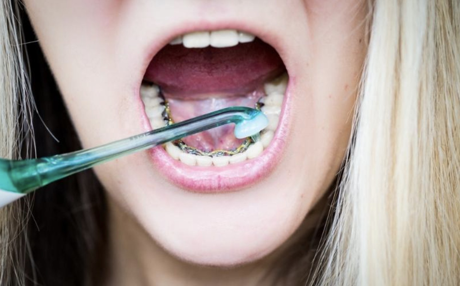Niềng răng mắc cài mặt lưỡi khó vệ sinh