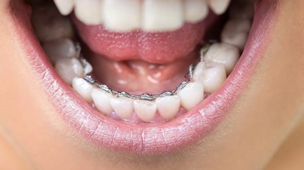Niềng răng mắc cài thẩm mỹ đảm bảo tính thẩm mỹ