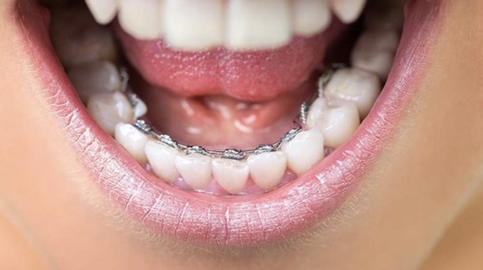 Niềng răng mắc cài thẩm mỹ đảm bảo tính thẩm mỹ