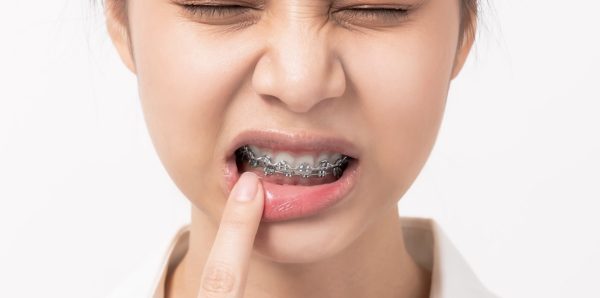Niềng răng mắc cài mặt trong hạn chế tổn thương răng và mô mềm