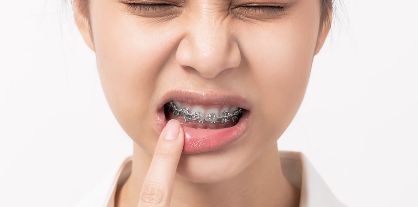 Niềng răng mắc cài mặt trong hạn chế tổn thương răng và mô mềm