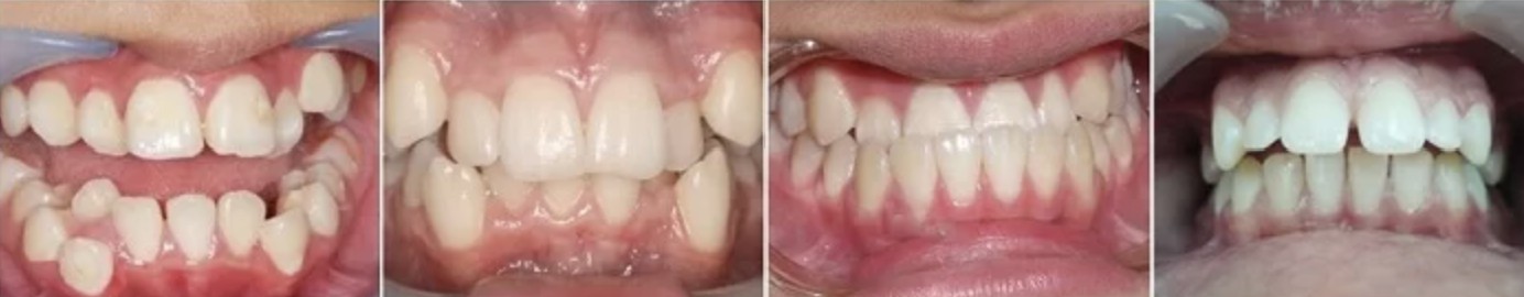 Các trường hợp có thể aniềng răng tháo lắp