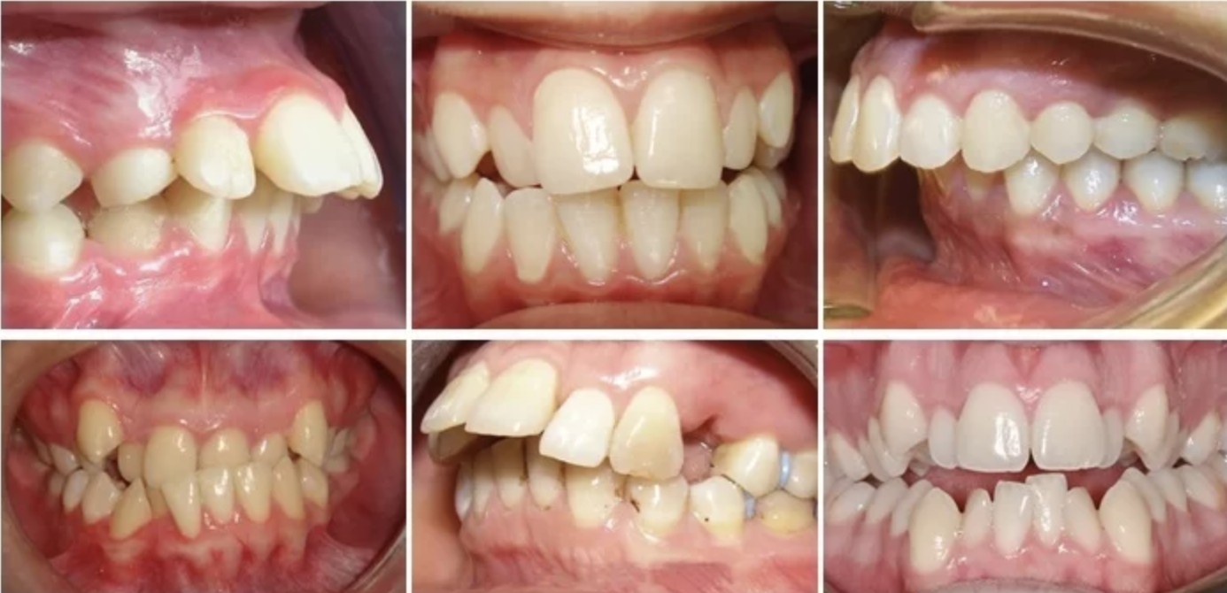 Các trường hợp sai lệch nhiều không thể niềng răng 1 hàm