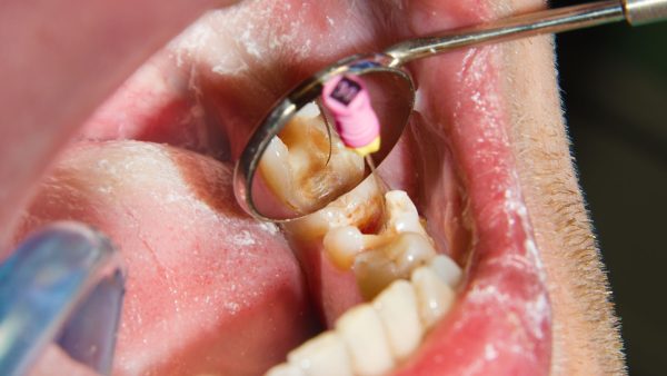 Răng đã lấy tủy vẫn niềng răng được và đạt kết quả tốt
