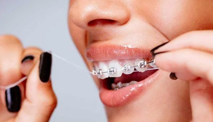 Răng đã lấy tủy vẫn niềng răng được và đạt kết quả tốt