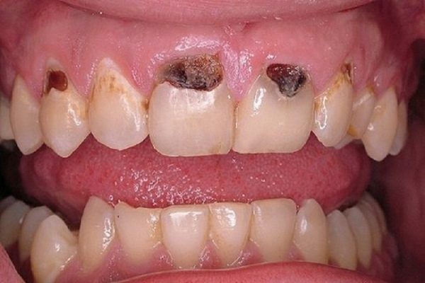 Răng bị sâu, vỡ nên không thể niềng răng