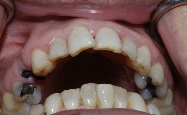 Trồng răng hàm bị sâu rất cần thiết