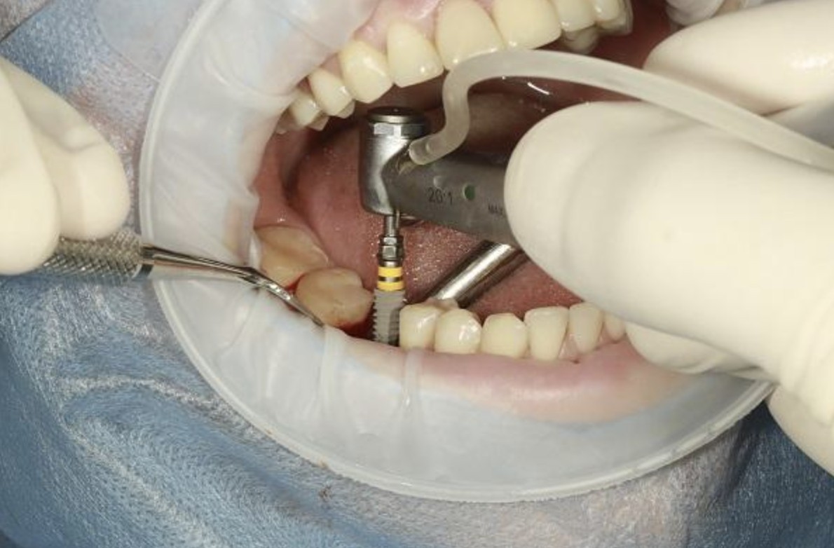 Trồng răng hàm bị sâu? Các phương pháp trồng hiệu quả