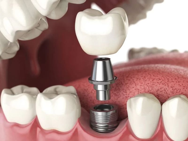 Chi phí trồng răng cấm (răng số 6 và số 7) dao động từ 200.000 – 35.000.000 đồng/răng.