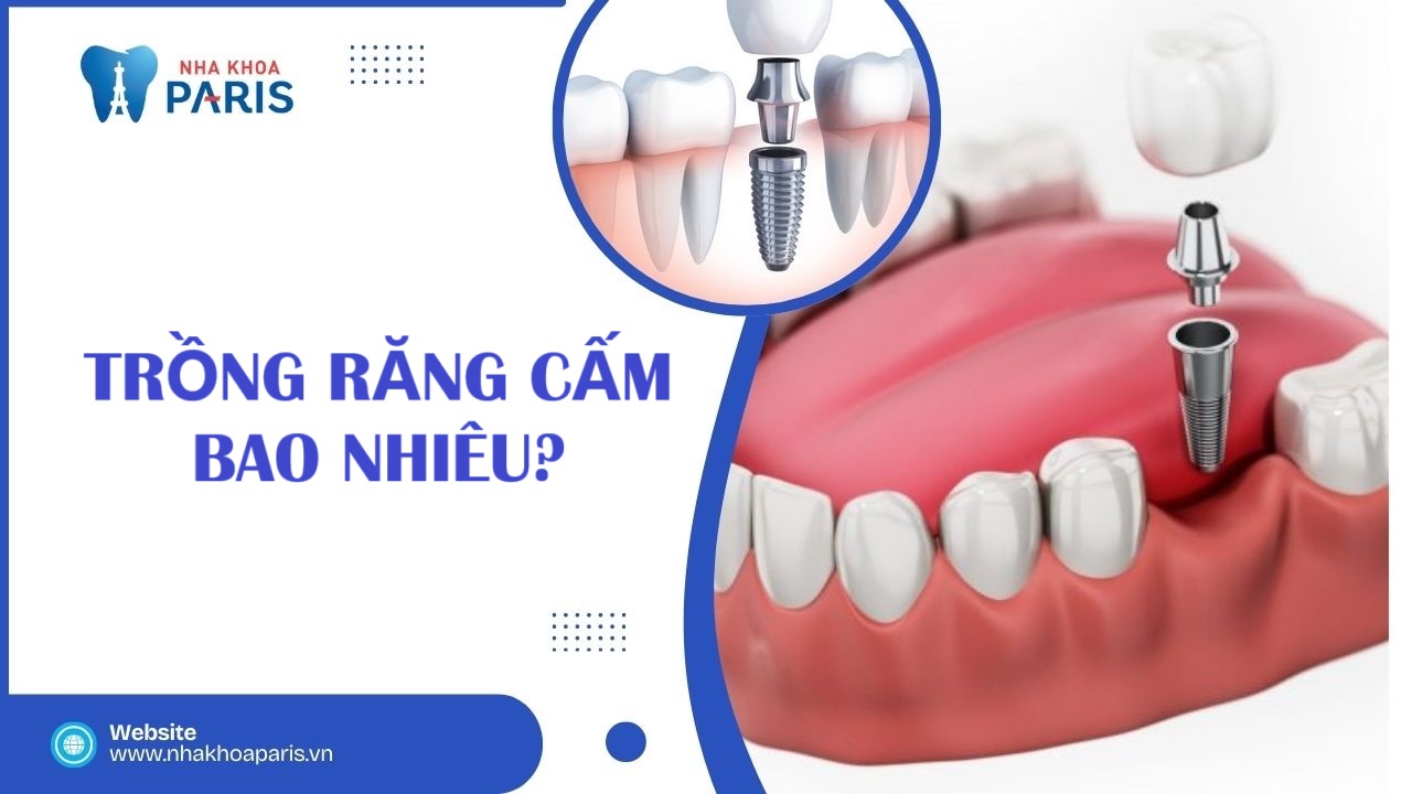 Trồng răng cấm hết bao nhiêu? Các yếu tố ảnh hưởng tới chi phí