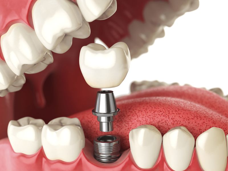 Trồng răng không gây ảnh hưởng tới sức khỏe