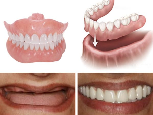 Nhược điểm của trồng răng giả bằng hàm tháo lắp