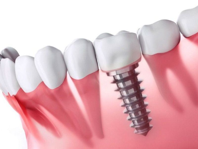 Trồng răng giả bị đau 2