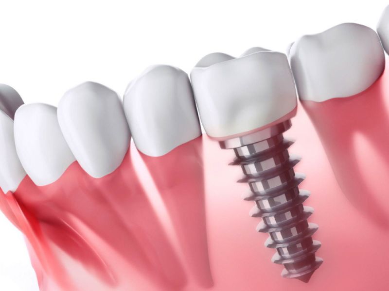 Trồng răng giả vẫn khiến nhiều người e ngại bởi nhiều nguyên nhân khác nhau.